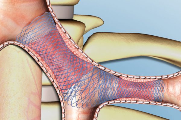 Carina-J-Stent_Anwendung