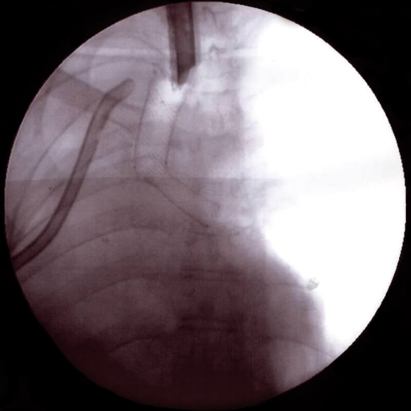 Carina-J-Stent_radio