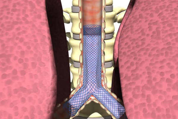 Carina-Y-Stent_Anwendung
