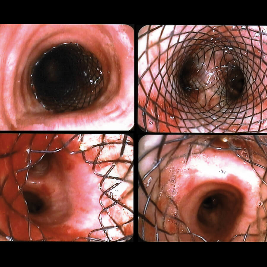 Carina-Y-Stent_befund