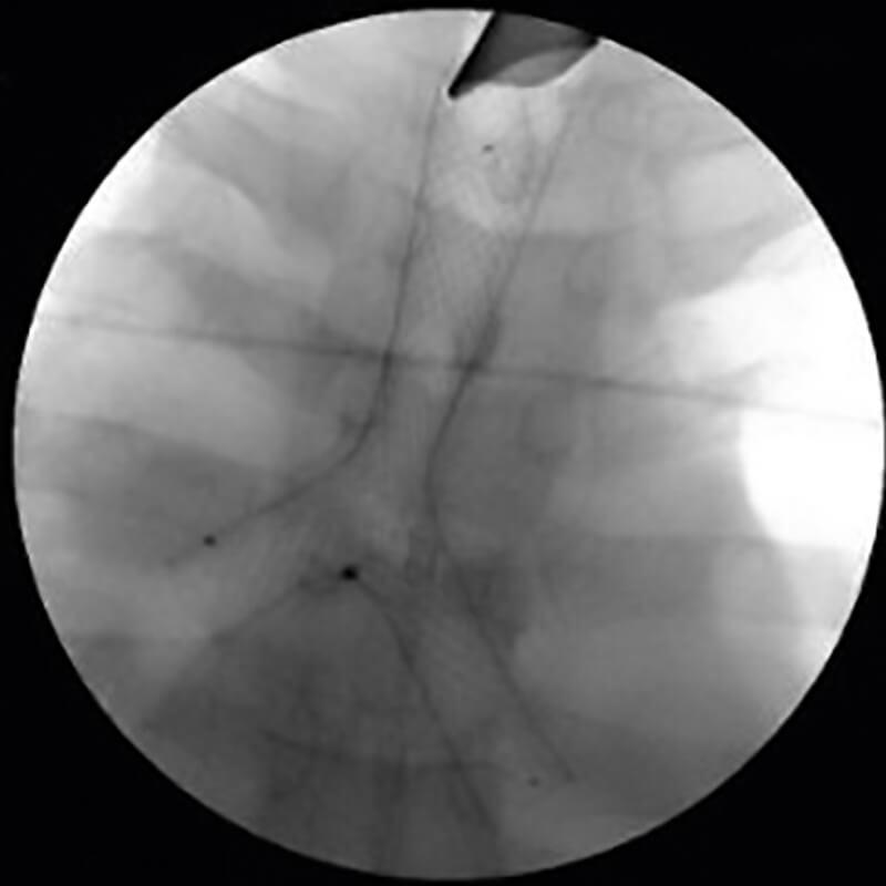Carina-Y-Stent_radio
