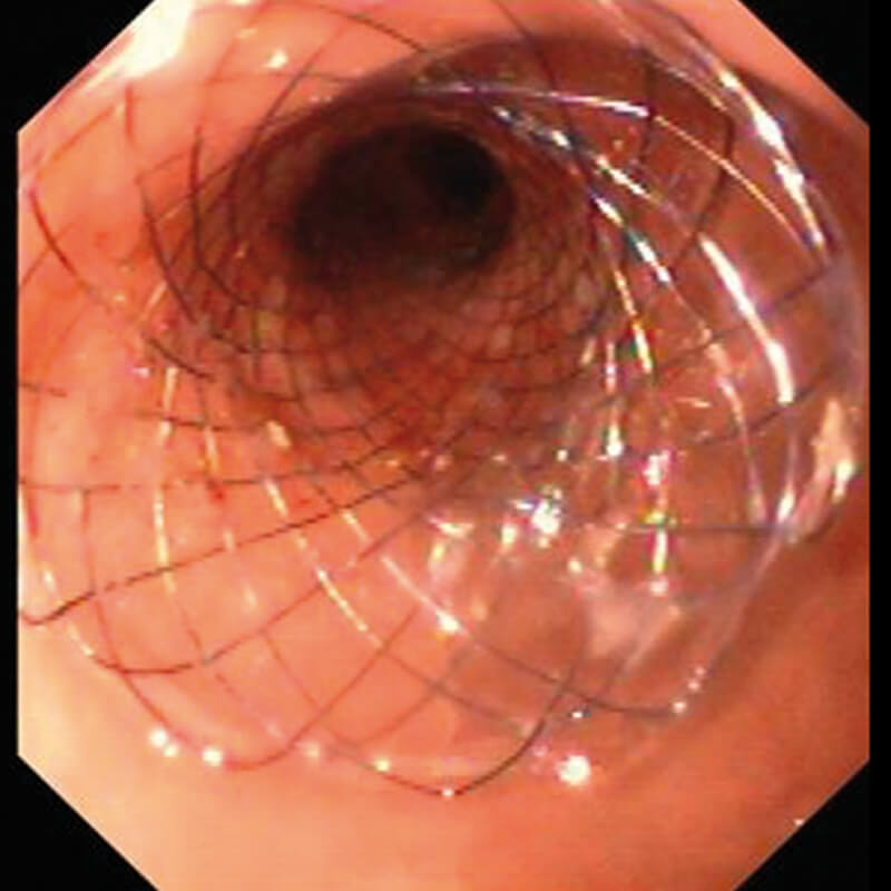 DUODENUM-befund