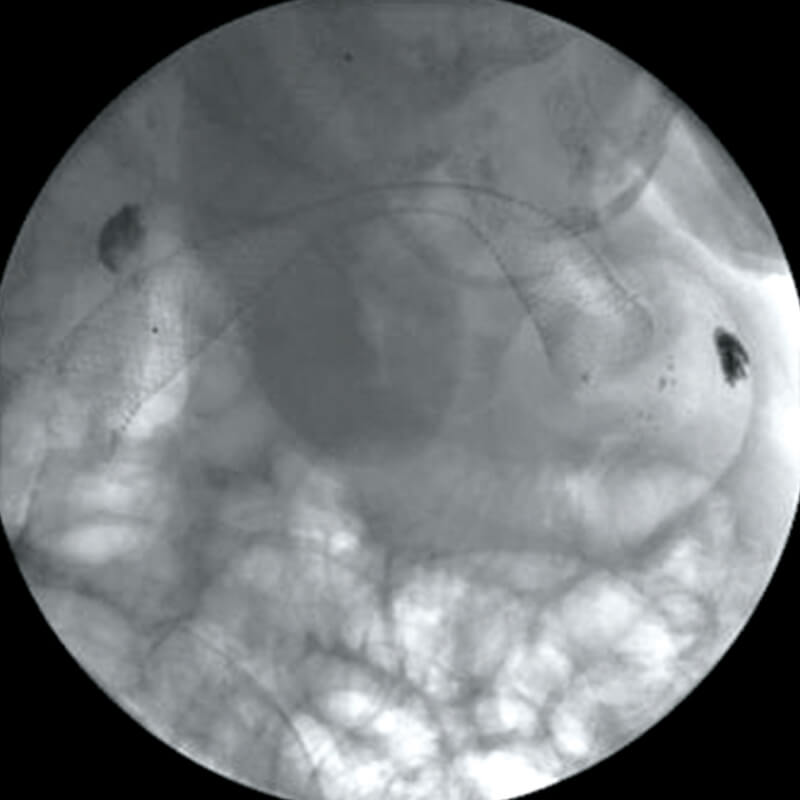 DUODENUM-radio2
