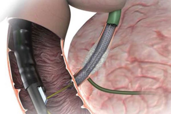 GALLENGANG-STENTS-anwendung