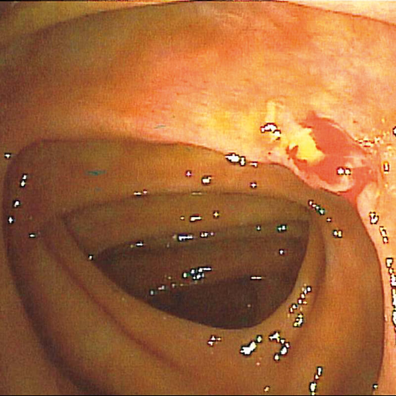 Hot-Biopsy Bedund1