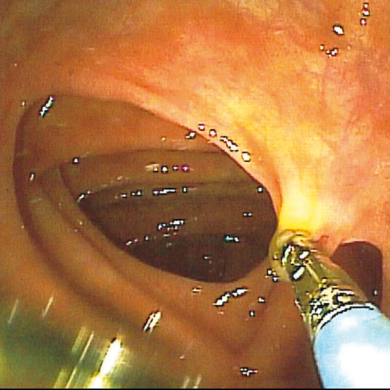 Hot-Biopsy Bedund2