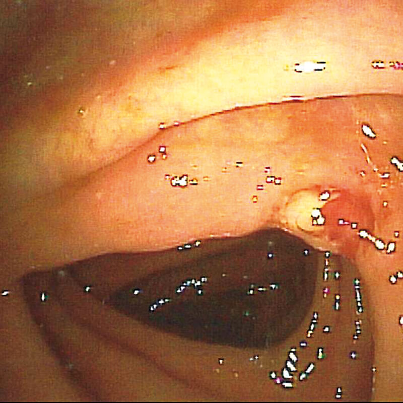 Hot-Biopsy Bedund3