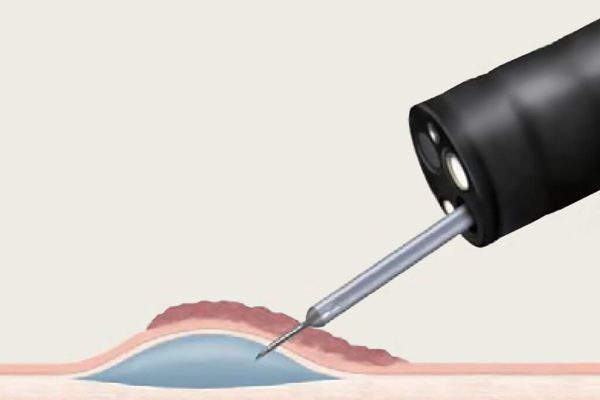 Needle Anwendung