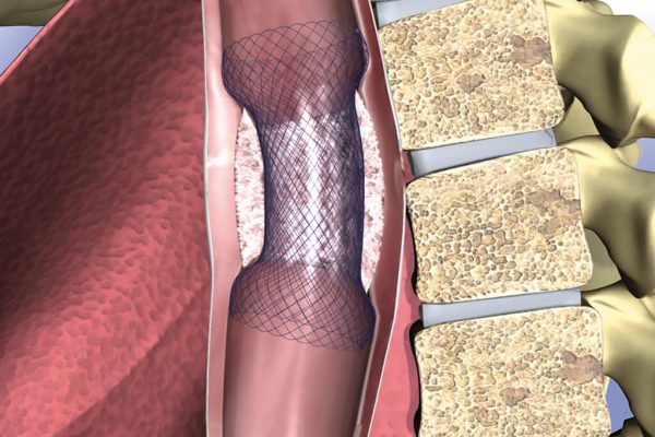 Oeso_Stent_Anwendung