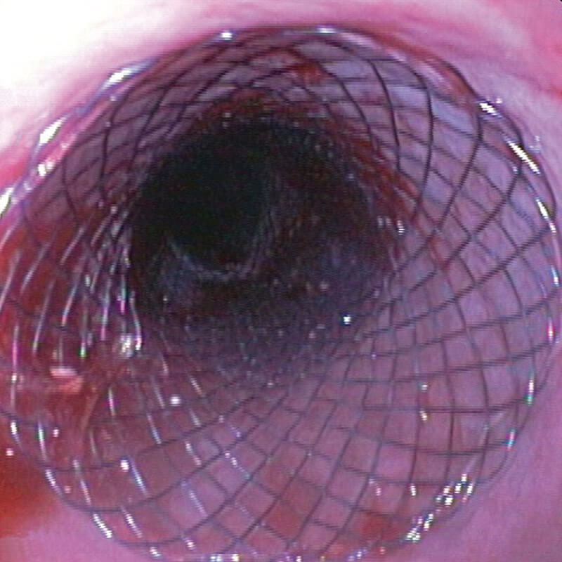 Oeso_Stent_Befund1