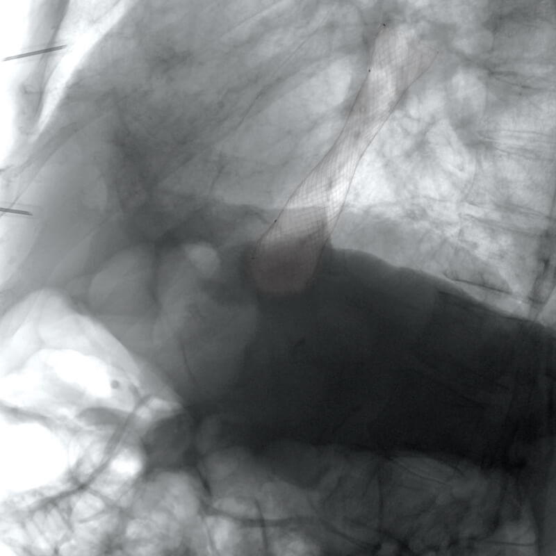 Oeso_Stent_Radio1