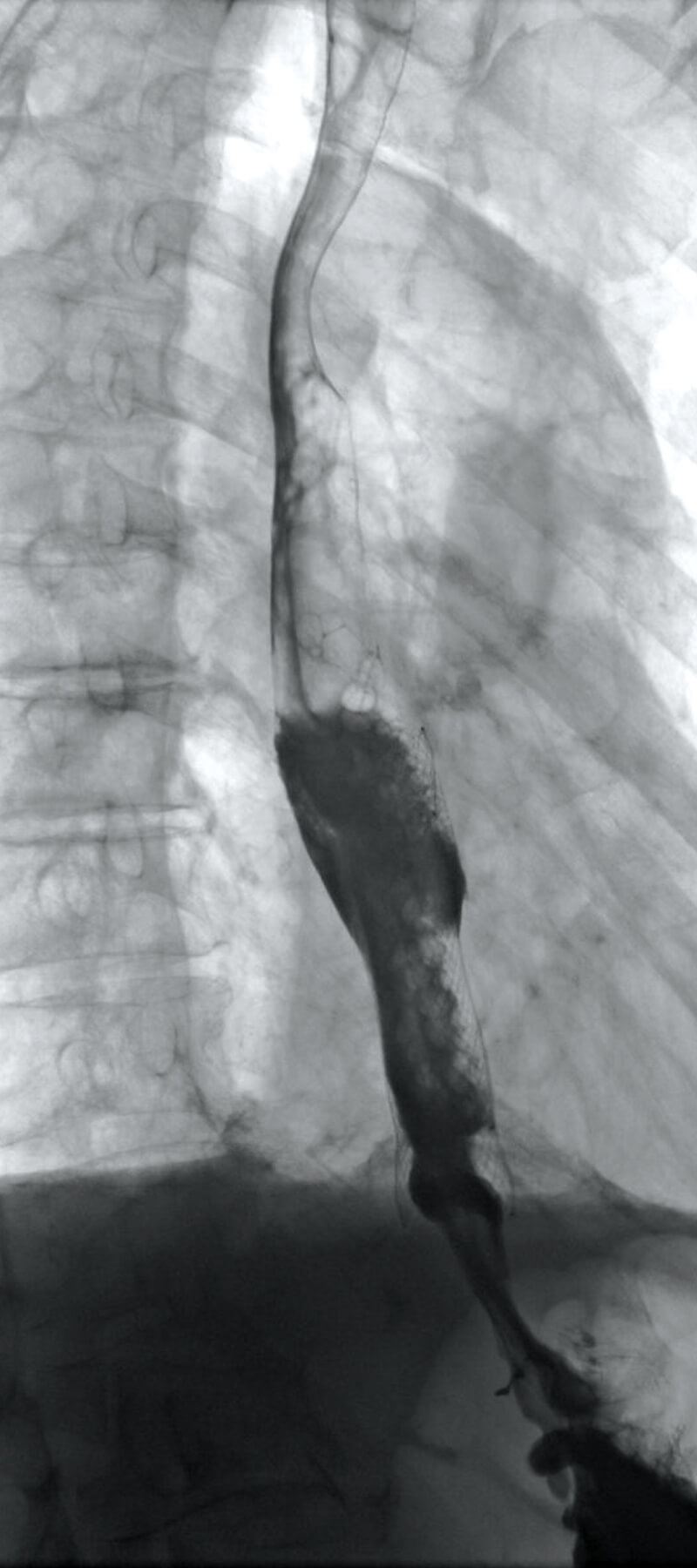 Oeso_Stent_Radio2