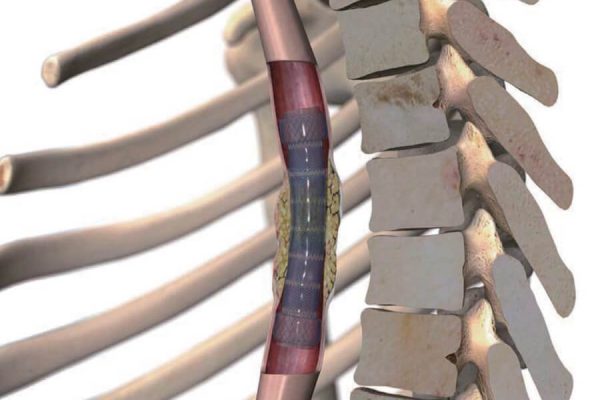 SEGMENTIERTER STENT_anwendung