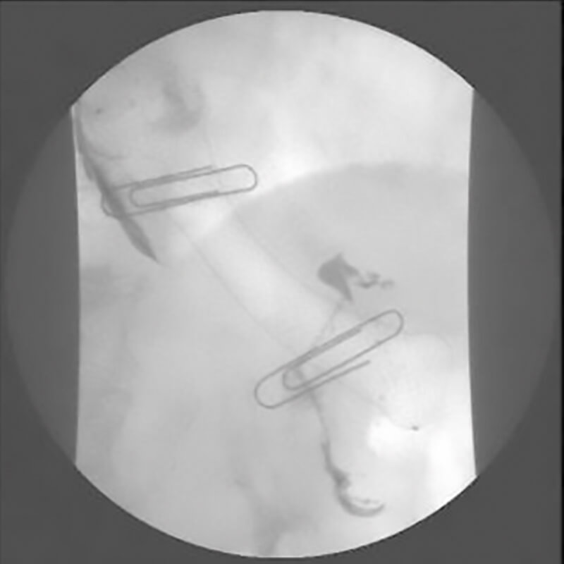 Softcup-Oeso_Stent_radio