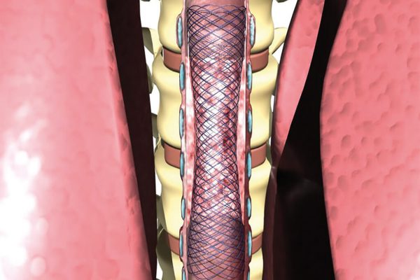 TRACHEAL-BRONCHIAL_anwendung