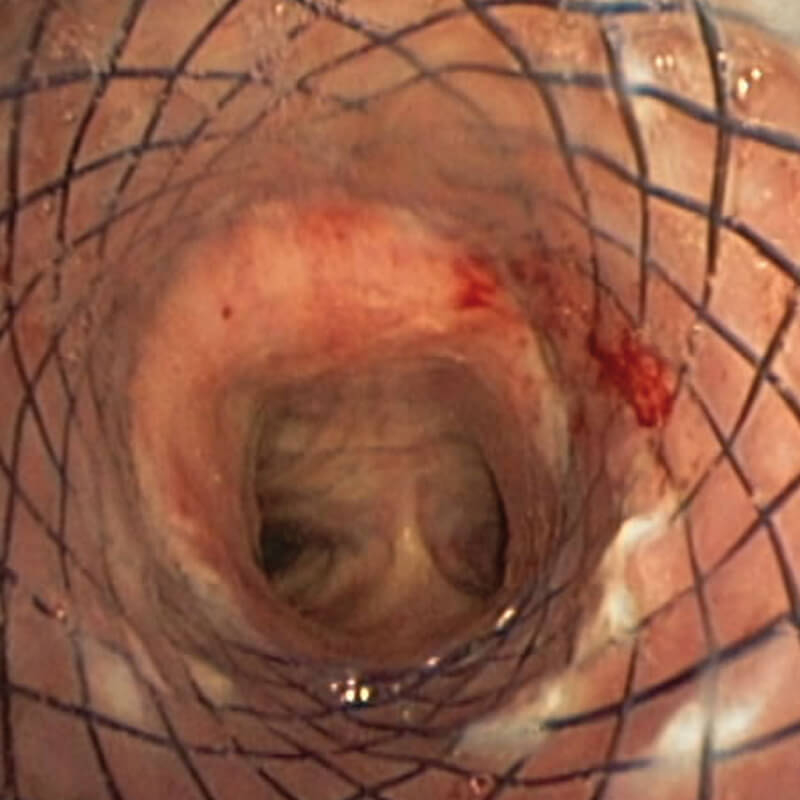 TRACHEAL-BRONCHIAL_befund1