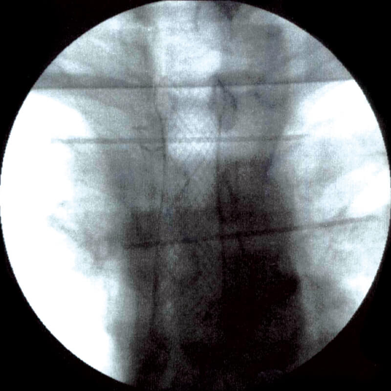 TRACHEAL-BRONCHIAL_radio1