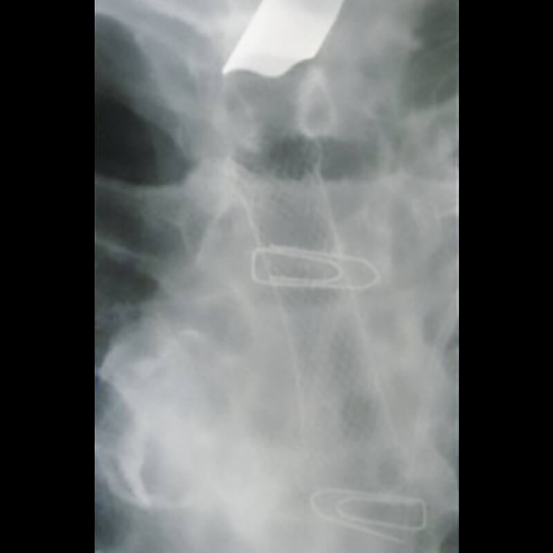 TRACHEAL-BRONCHIAL_radio2