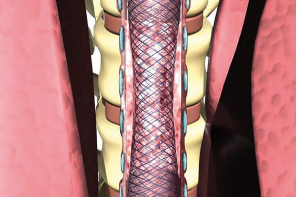 TRACHEAL-BRONCHIAL_anwendung-1000x500_EN